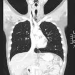 Radiología de Tórax con Tomografía ($ARS)